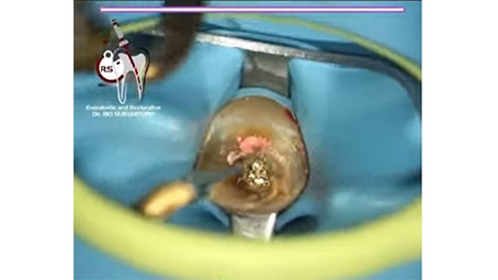 A Clinical Case by Dr. Rio Suryantoro with Eighteeth Ultra X Gold Tip