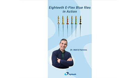 A Clinical Case by Dr. Moh'd Hammo with Eighteeth E-Flex Blue
