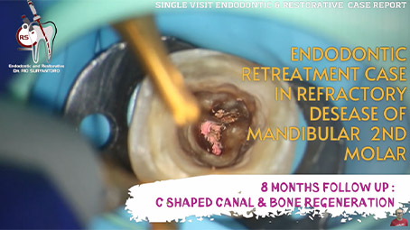Refractory endodontic case, 8 months bone regeneration, C-shaped canal, hermetic bioceramic sealer