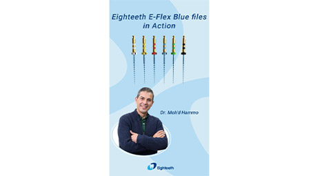 A Clinical Case by Dr. Moh'd Hammo with Eighteeth E-Flex Blue