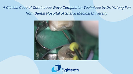 A Clinical Case of Continuous Wave Compaction Technique by Dr. Yufeng Fan