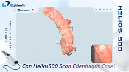 Helios 500 Can Scan Edentulous Case Smoothly