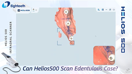 Helios 500 Can Scan Edentulous Case Smoothly