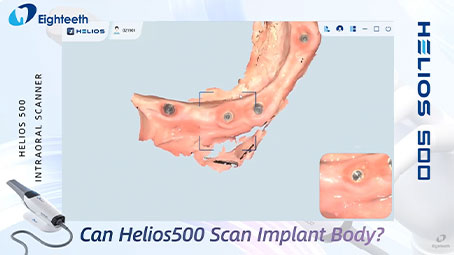 Helios 500 Can Scan Implant Body Smoothly