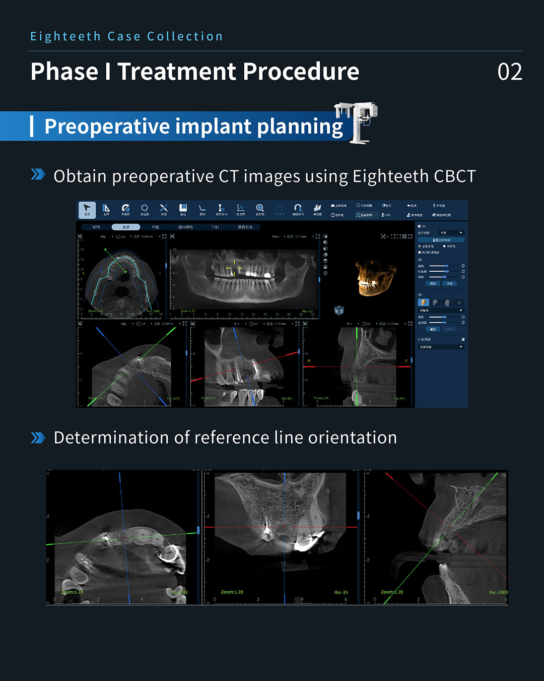 #11、#13 lmplant & Restoration Treatment, #12 Root Canal Retreatment4_1