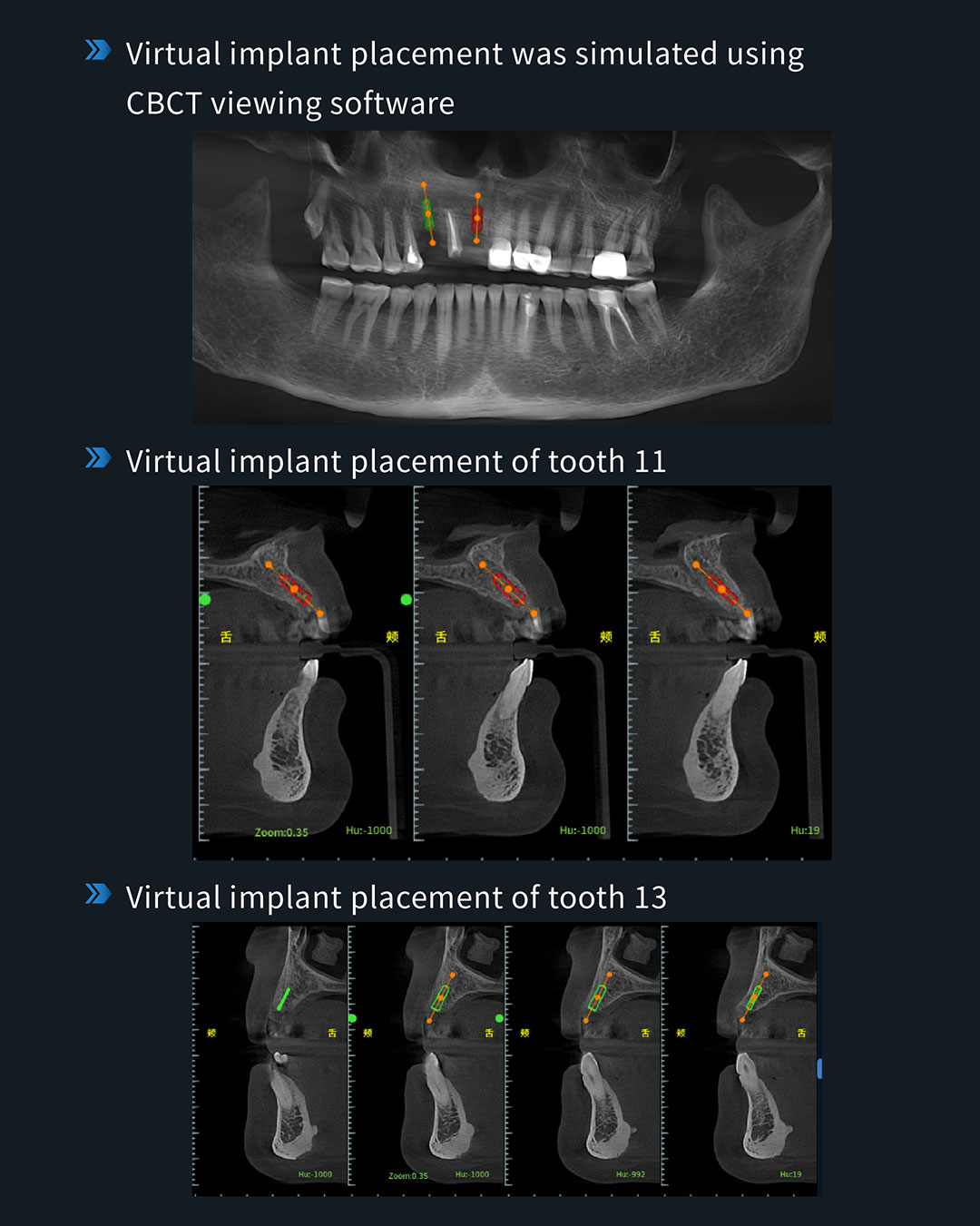 #11、#13 lmplant & Restoration Treatment, #12 Root Canal Retreatment6_1