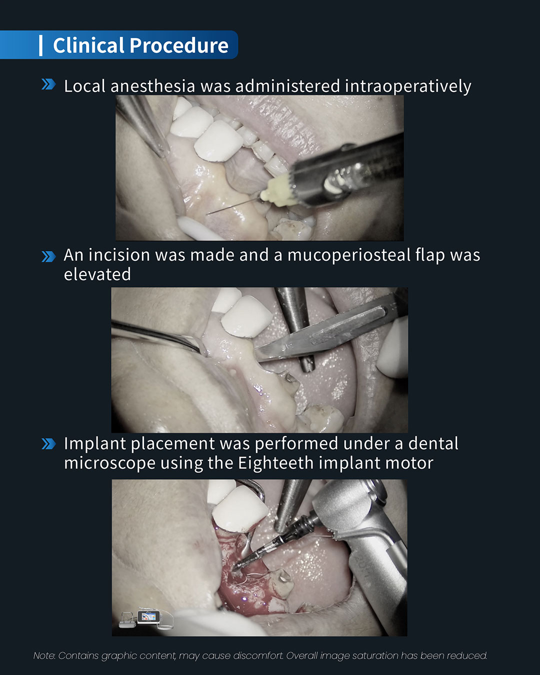 #11、#13 lmplant & Restoration Treatment, #12 Root Canal Retreatment7_1