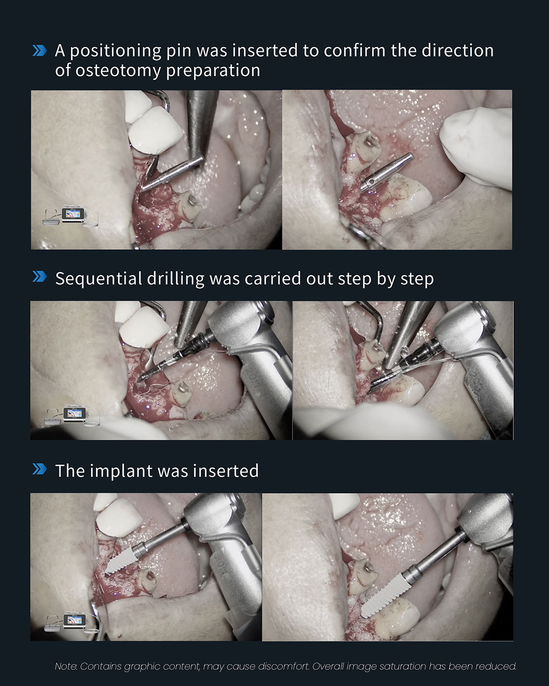 #11、#13 lmplant & Restoration Treatment, #12 Root Canal Retreatment8_1