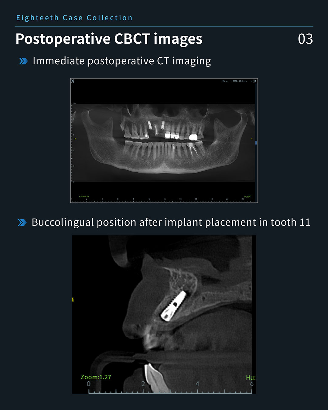 #11、#13 lmplant & Restoration Treatment, #12 Root Canal Retreatment9_1