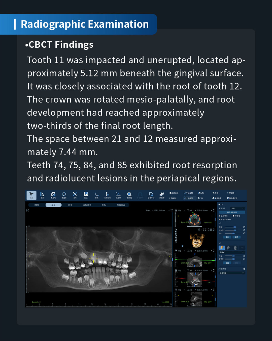 Impacted Unerupted 11, Anterior Crossbite of 21, and Chronic Apical Periodont_4
