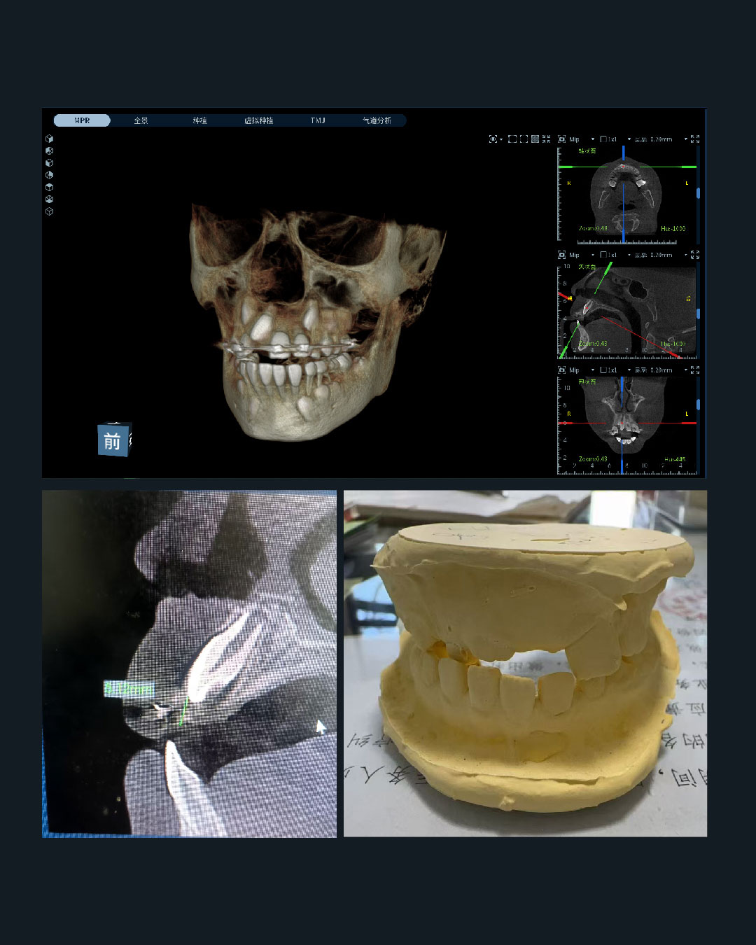 Impacted Unerupted 11, Anterior Crossbite of 21, and Chronic Apical Periodont_6