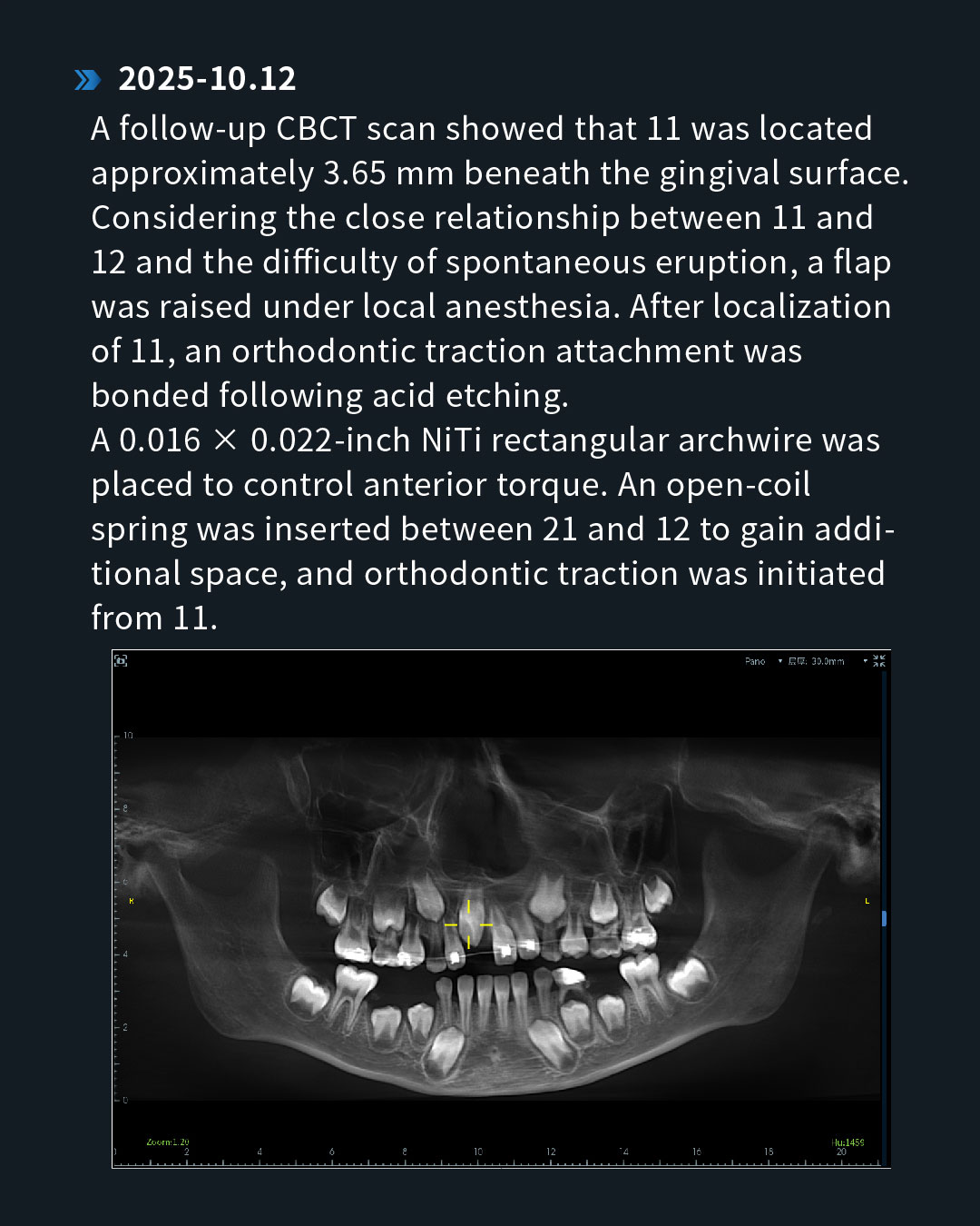 Impacted Unerupted 11, Anterior Crossbite of 21, and Chronic Apical Periodont_7