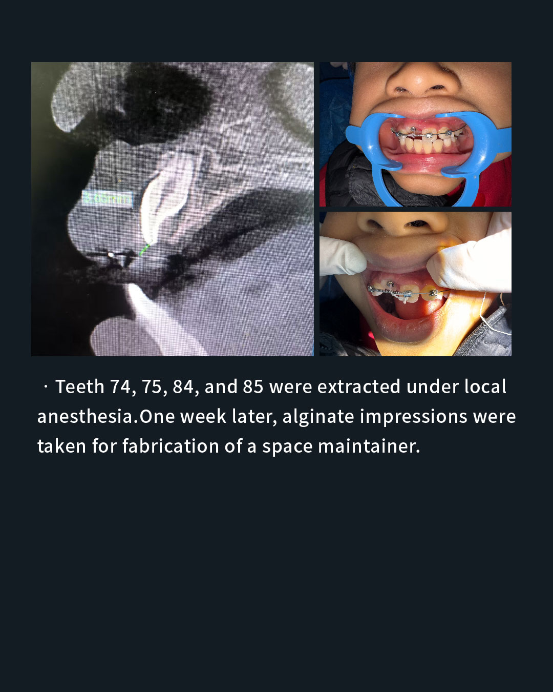 Impacted Unerupted 11, Anterior Crossbite of 21, and Chronic Apical Periodont_8