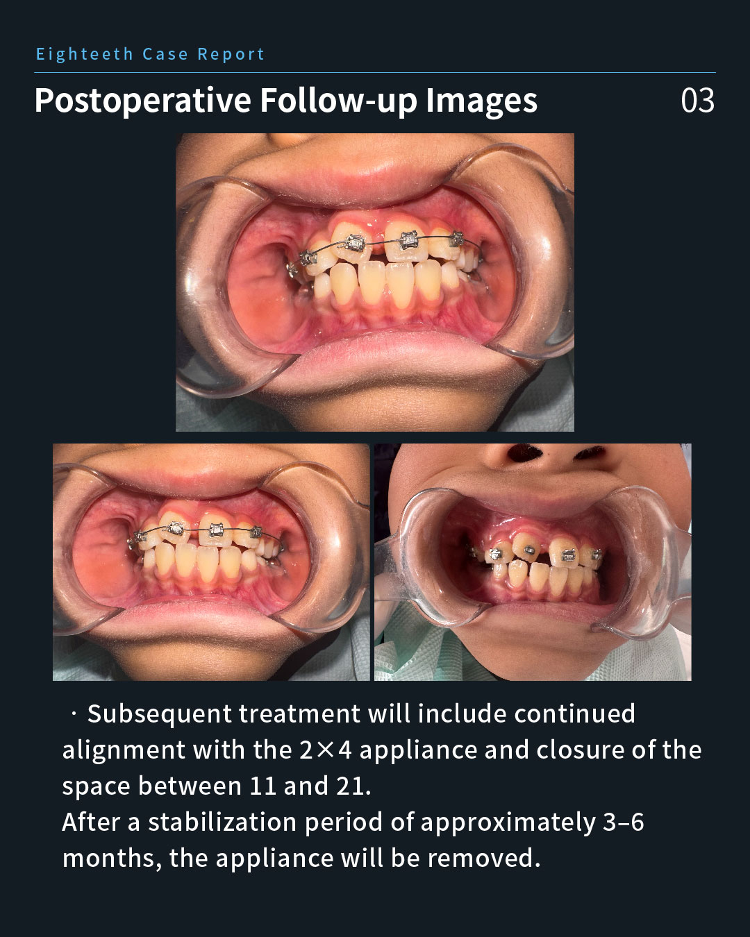 Impacted Unerupted 11, Anterior Crossbite of 21, and Chronic Apical Periodont_9