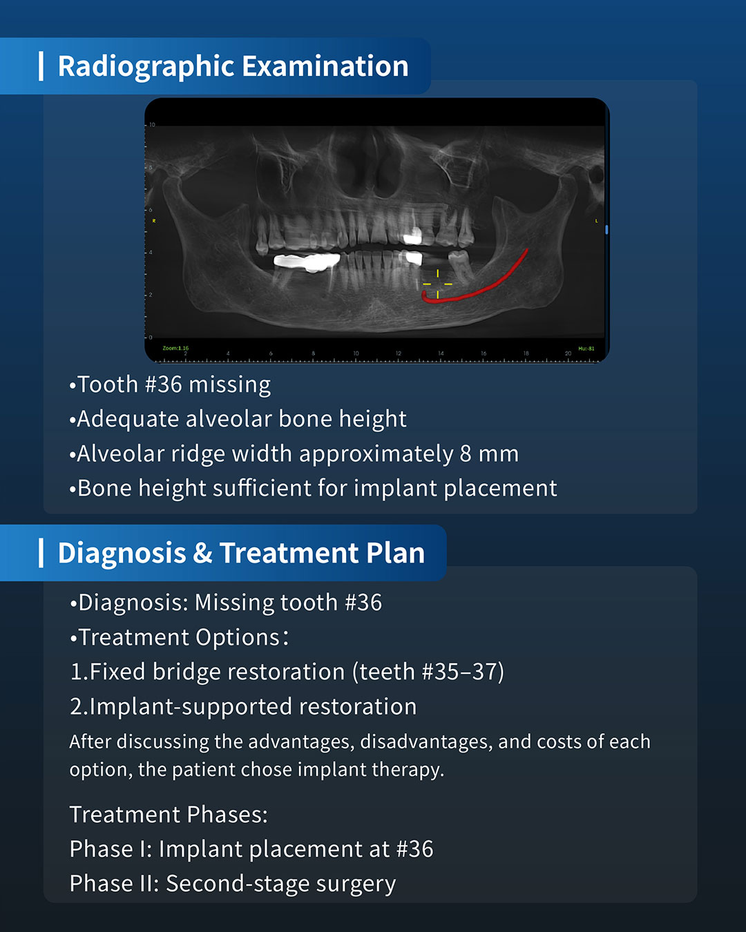 Implant Placement in Tooth #36 3_1