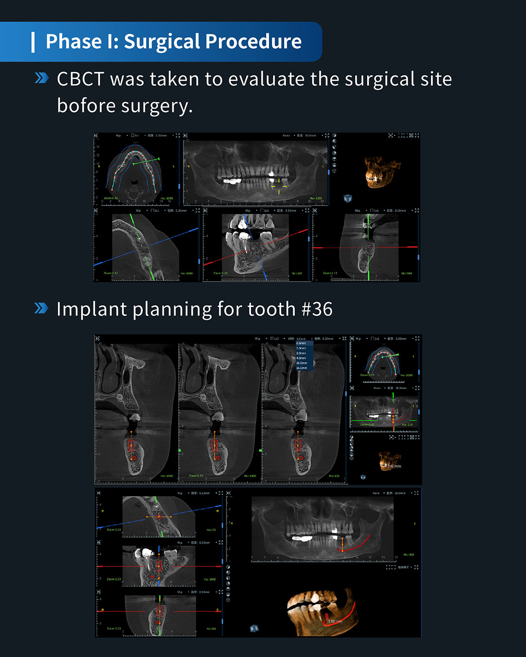 Implant Placement in Tooth #36 4_1