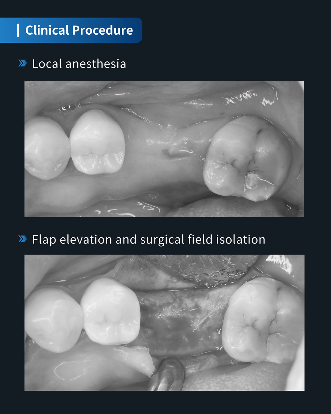 Implant Placement in Tooth #36 5_1