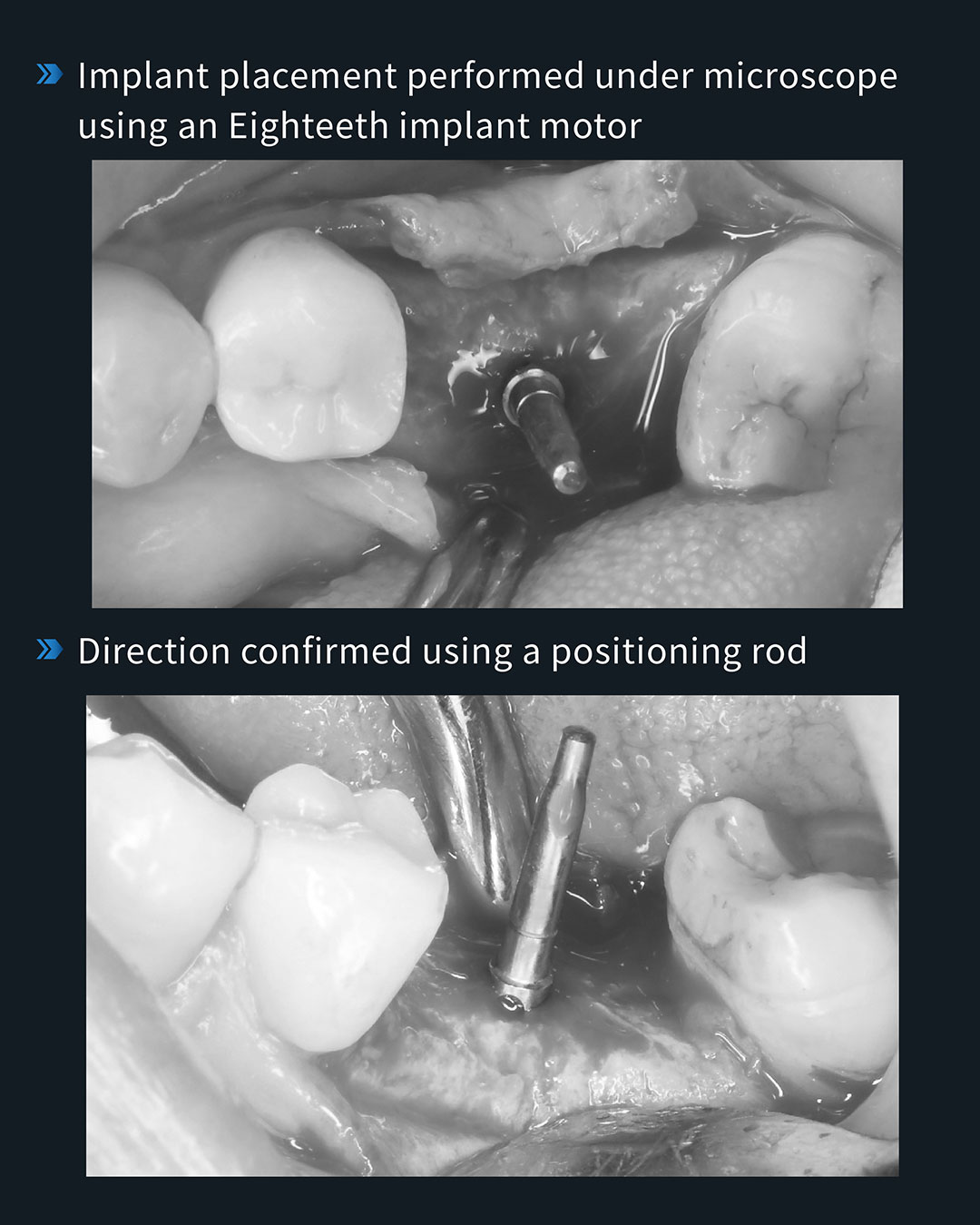 Implant Placement in Tooth #36 6_1
