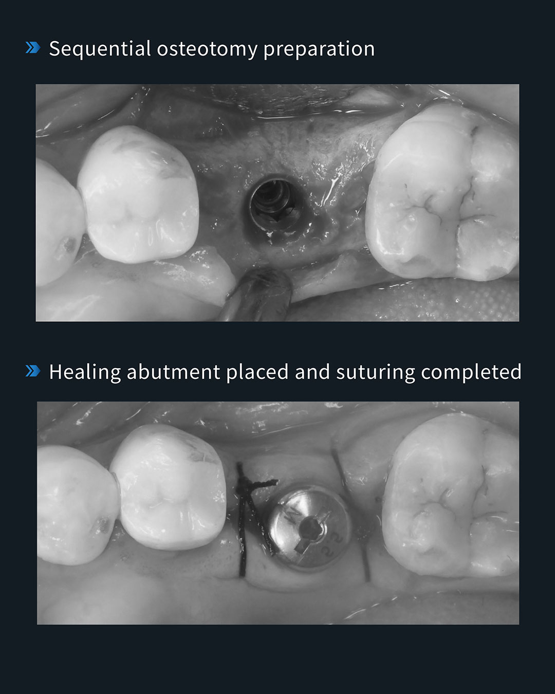 Implant Placement in Tooth #36 7_1
