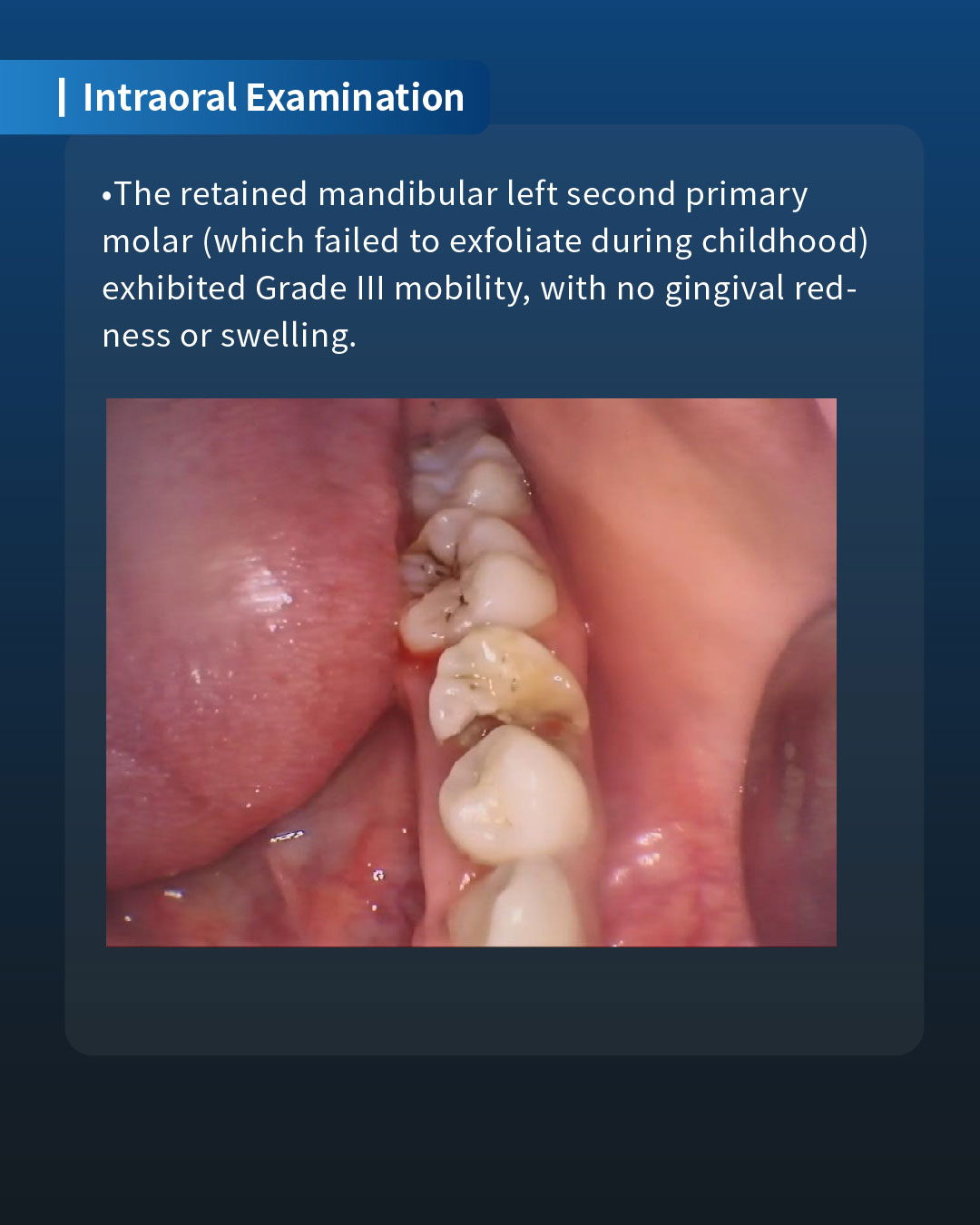 Implant Restoration of a Retained Mandibular Left Second Primary Molar3_1
