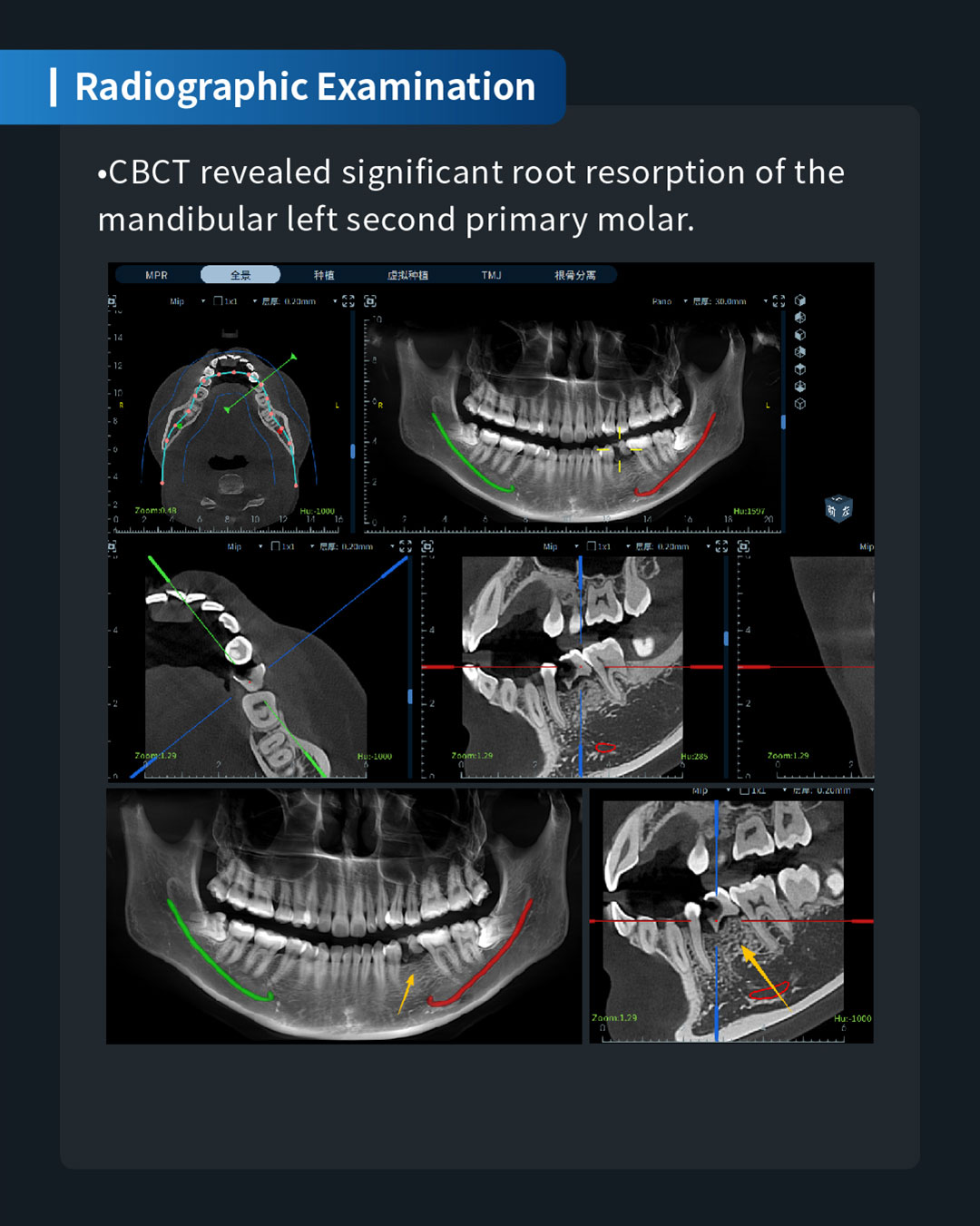 Implant Restoration of a Retained Mandibular Left Second Primary Molar4_1