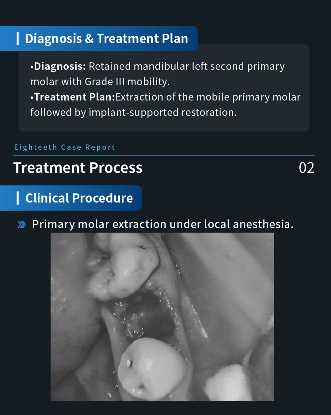 Implant Restoration of a Retained Mandibular Left Second Primary Molar5_1