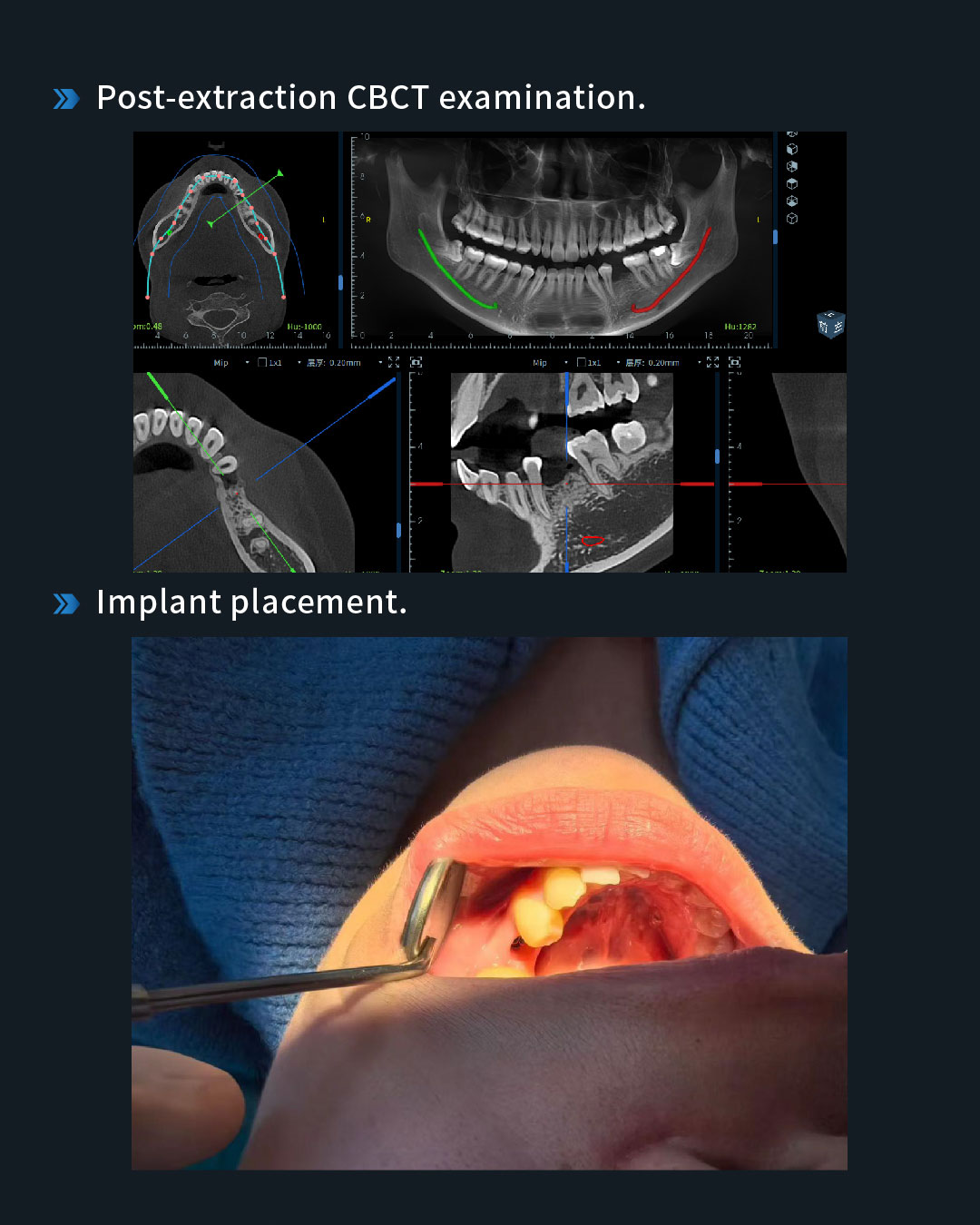 Implant Restoration of a Retained Mandibular Left Second Primary Molar6_1