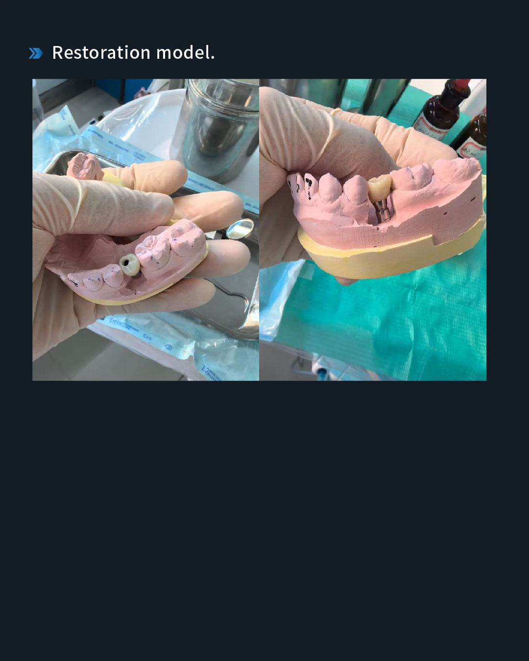 Implant Restoration of a Retained Mandibular Left Second Primary Molar7_1