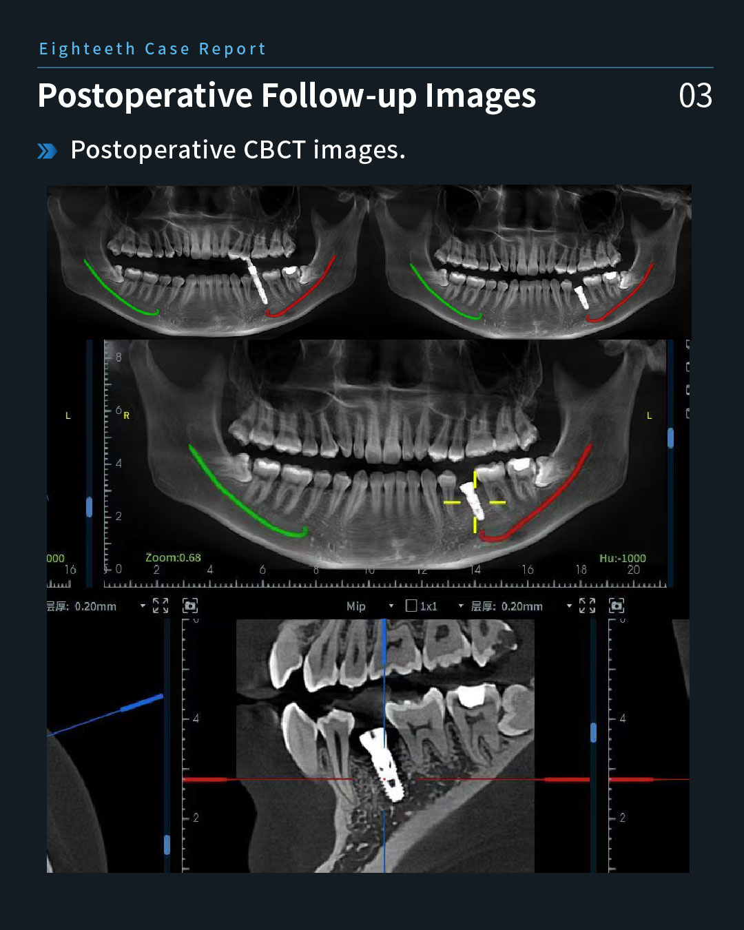 Implant Restoration of a Retained Mandibular Left Second Primary Molar8_1