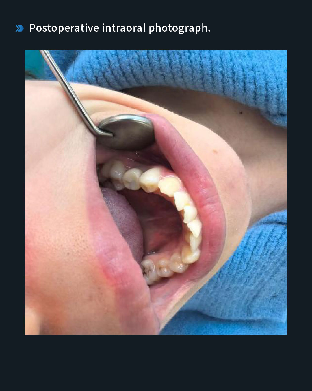 Implant Restoration of a Retained Mandibular Left Second Primary Molar9_1